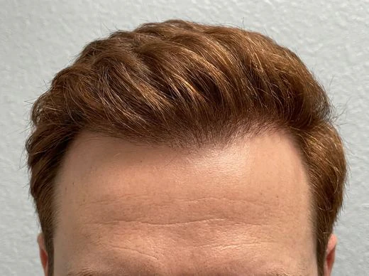 Customer hairline after