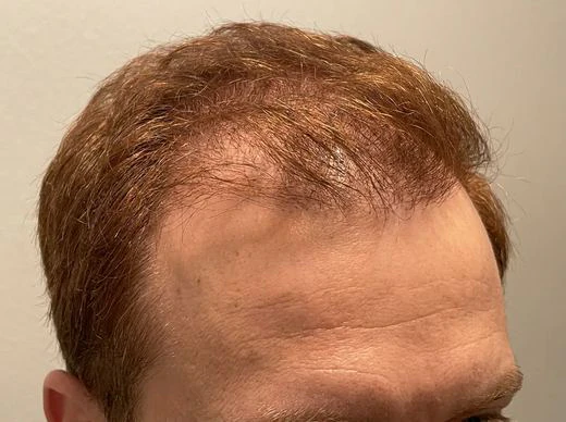 Customer hairline before