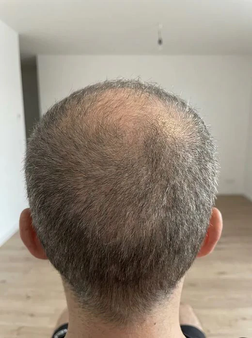 Customer crown before